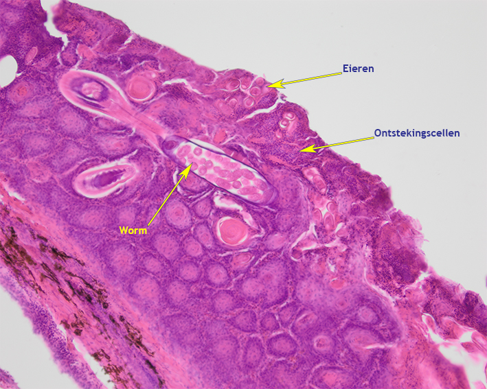 Histologisch beeld van de massa in de snavelholte met eieren, worm (met eieren) en ontstekingscellen.